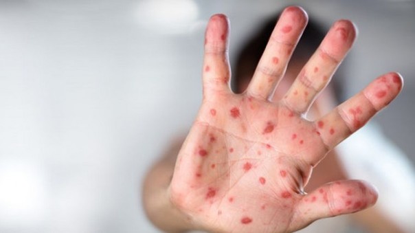 За неделю в Украине корью заболели 783 человека, умер новорожденный ребенок