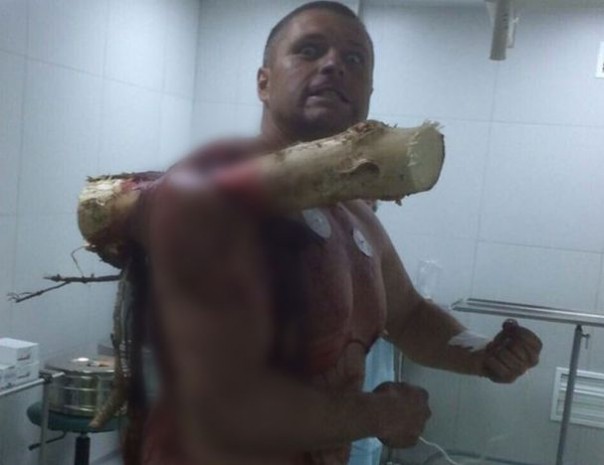 Проткнуло бревном насквозь. Белорусский пилот мотопараплана показал жуткую рану