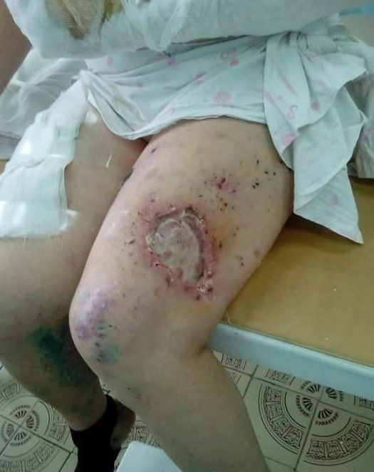 Хунта использует фосфорные снаряды против гражданского населения Хунта использует фосфорные снаряды против гражданского населения