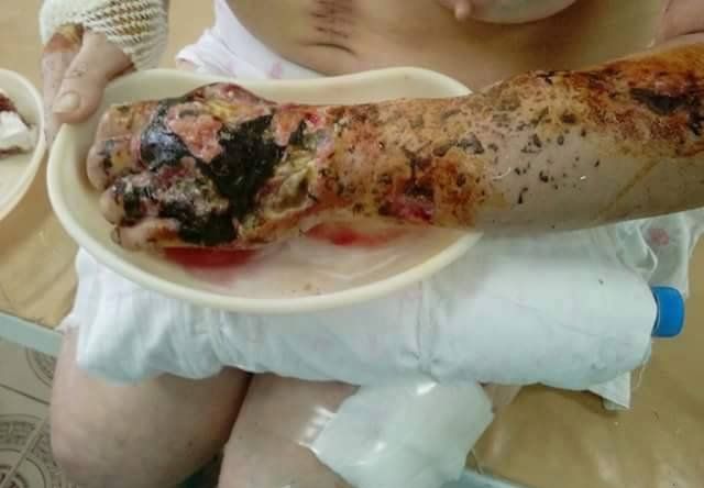 Хунта использует фосфорные снаряды против гражданского населения Хунта использует фосфорные снаряды против гражданского населения