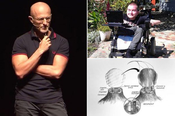 Пересадка головы: первым кандидатом стал русский программист