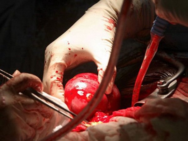 Облегчат ли жизнь черным трансплантологам на Украине? Облегчат ли жизнь черным трансплантологам на Украине?