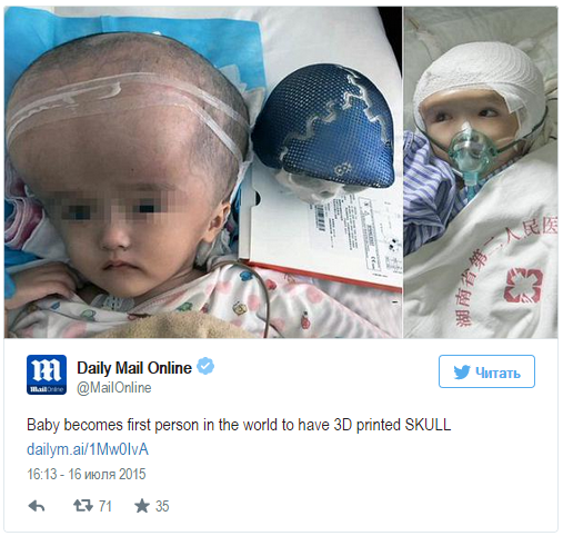 В Китае трехлетней девочке пересадили череп, напечатанный на 3D-принтере В Китае трехлетней девочке пересадили череп, напечатанный на 3D-принтере