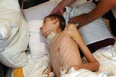 В Запорожье вспышка менингита