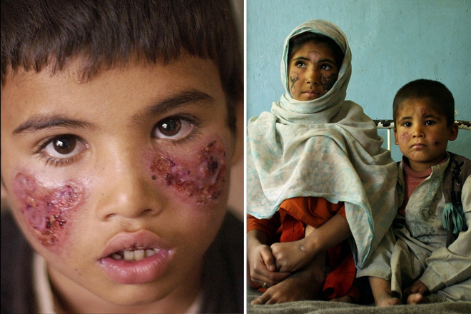 ДАИШ распространяет в Сирии болезнь, разъедающую плоть ДАИШ распространяет в Сирии болезнь, разъедающую плоть