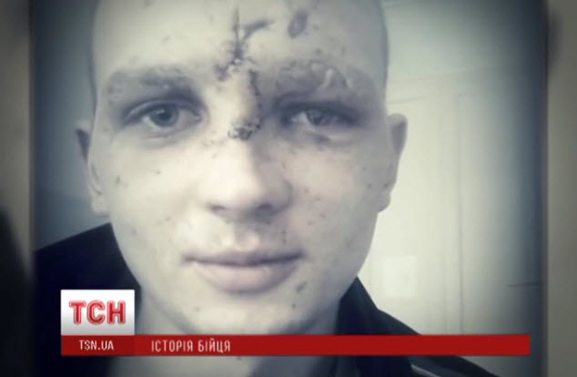 Причуды могилизации. Ослепшего после ранения на один глаз укровоина снова отправили на фронт